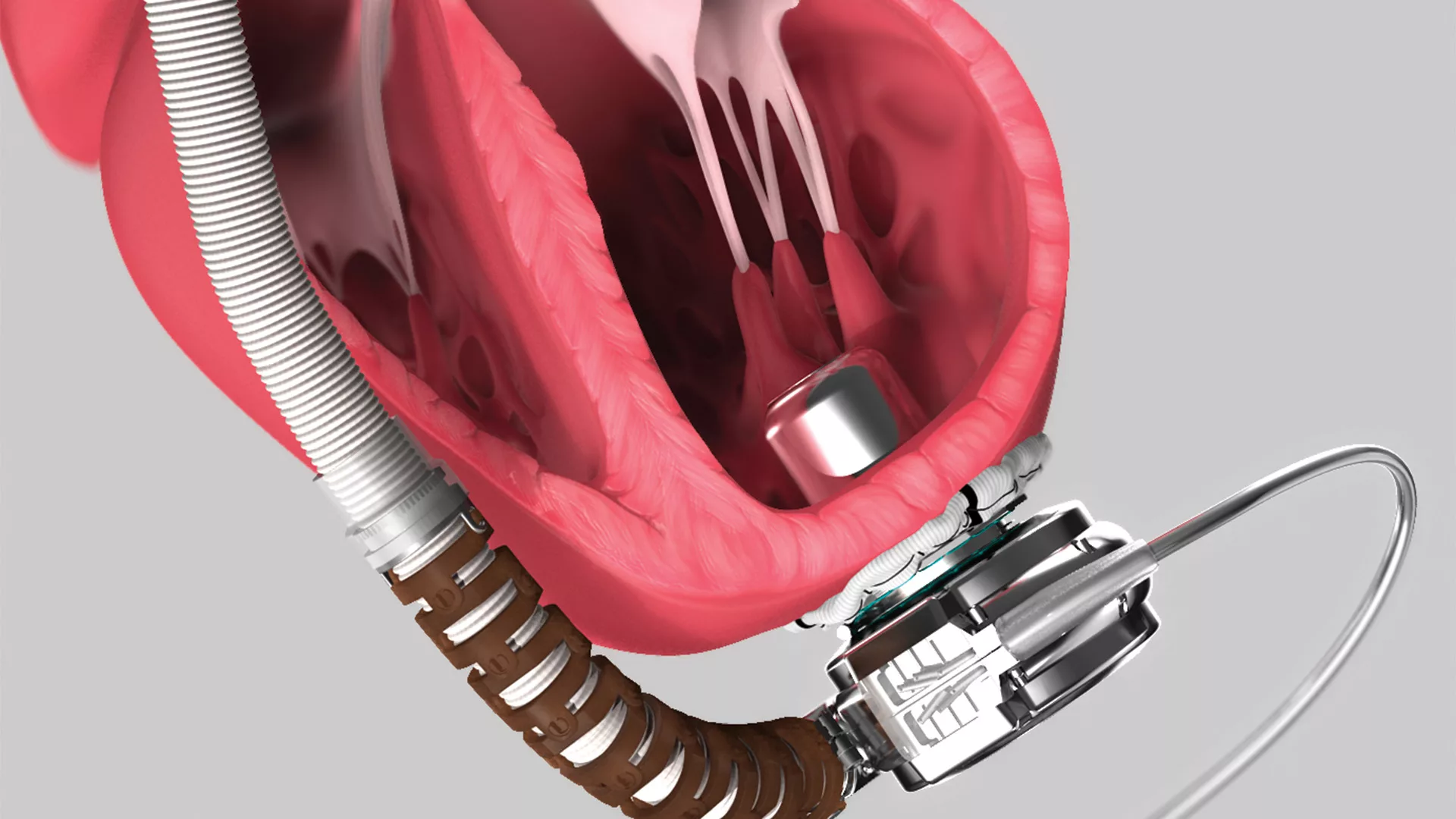 Saudi Arabia Performs Its First Robot-Assisted Implantation of an Artificial Heart Pump